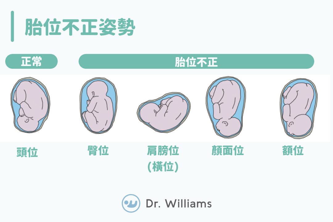 胎位不正姿勢