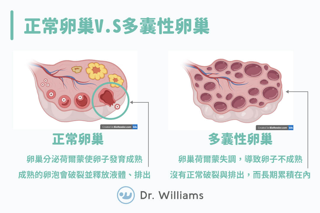 正常卵巢V.S多囊性卵巢