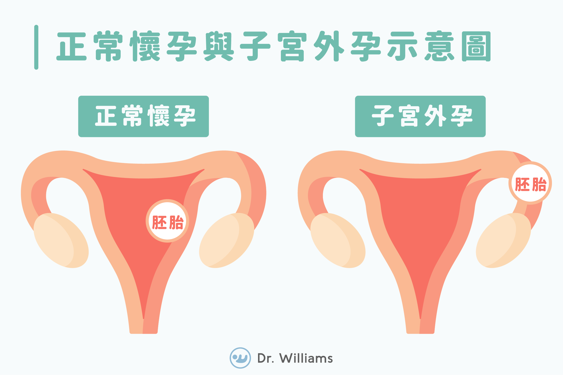 子宮外孕是什麼？