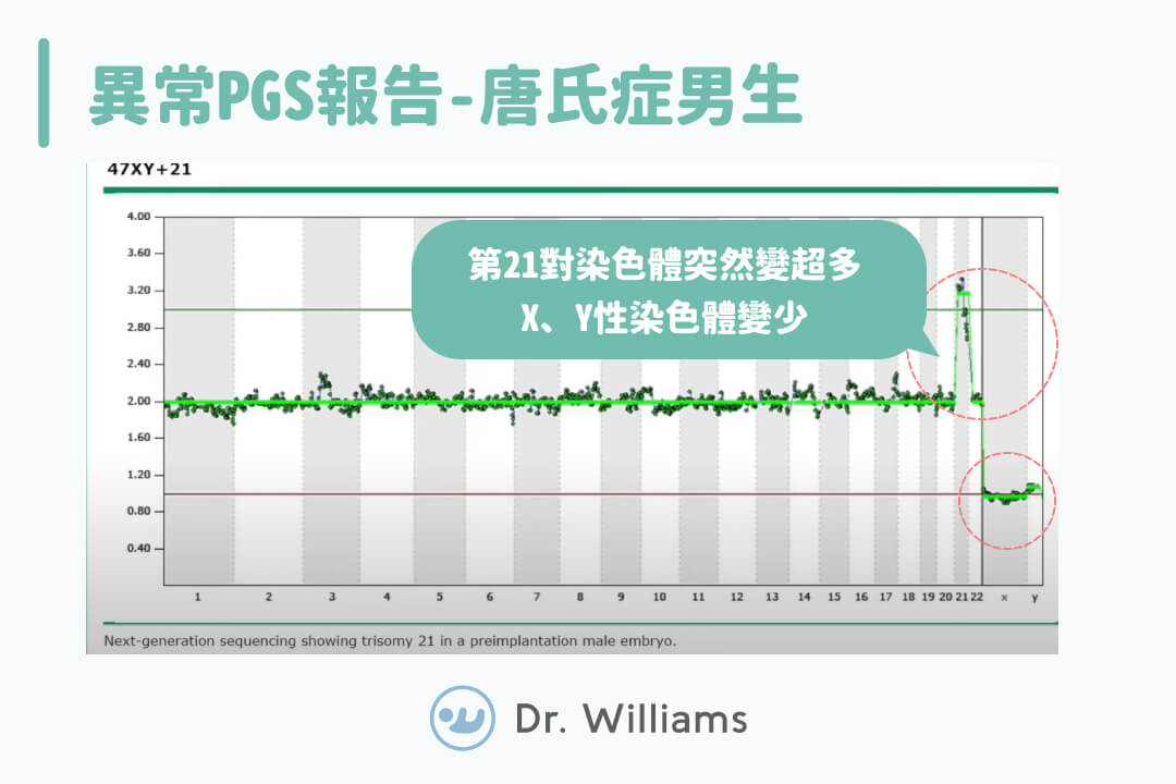 唐氏症男生的PGS報告範例