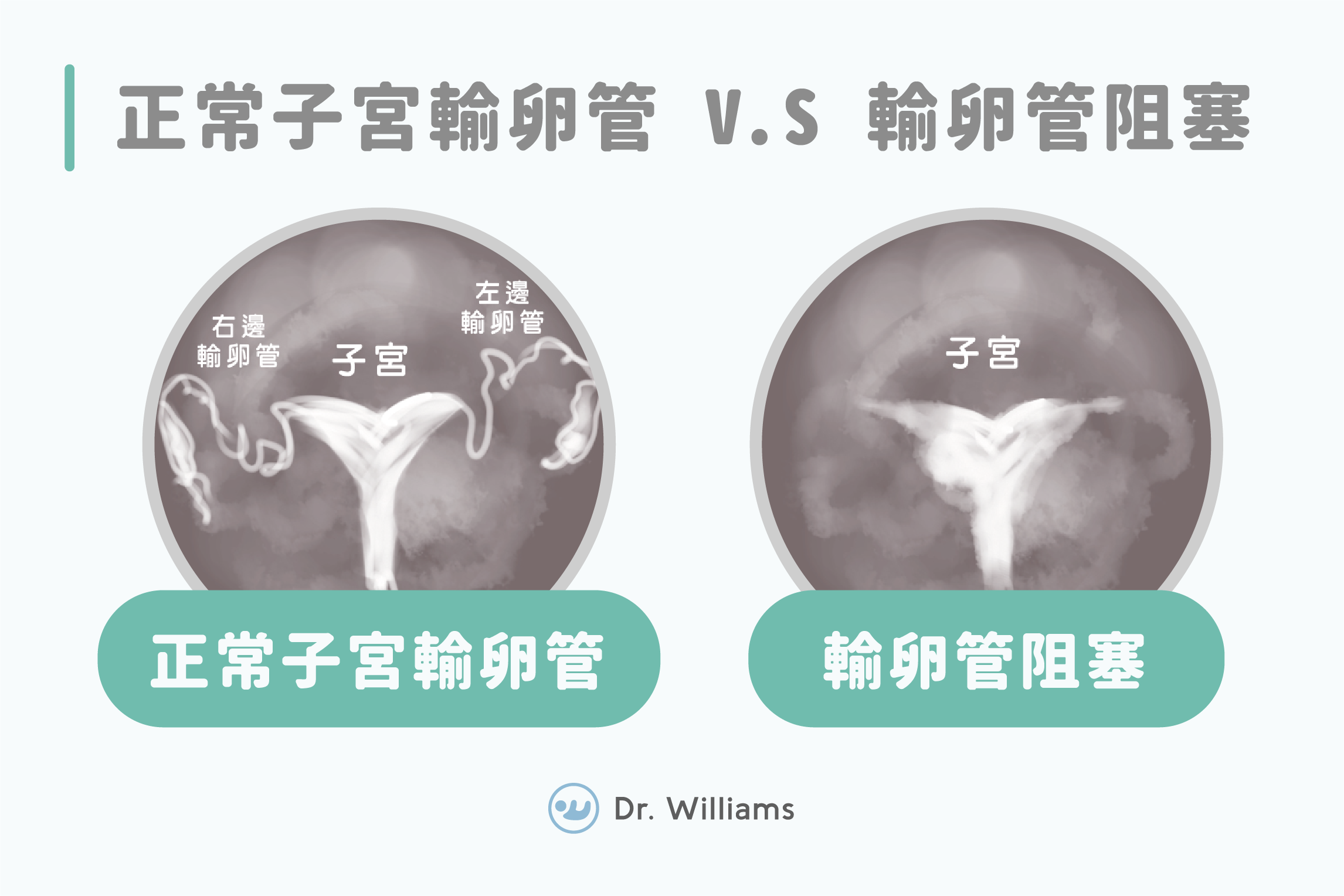 什麼是輸卵管攝影