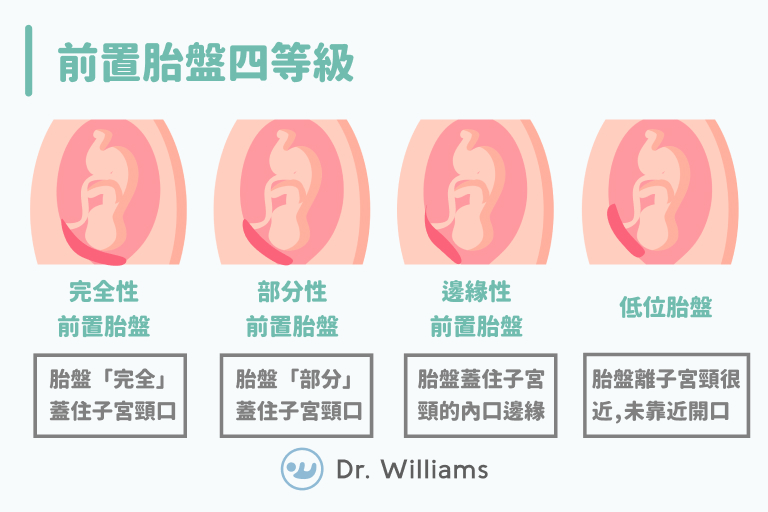 前置胎盤四等級妳知道嗎?