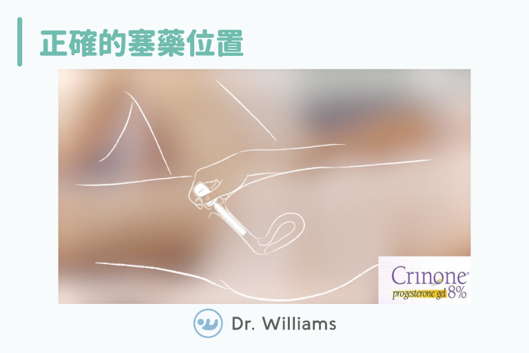 塞快孕隆、普捷生的正確位置