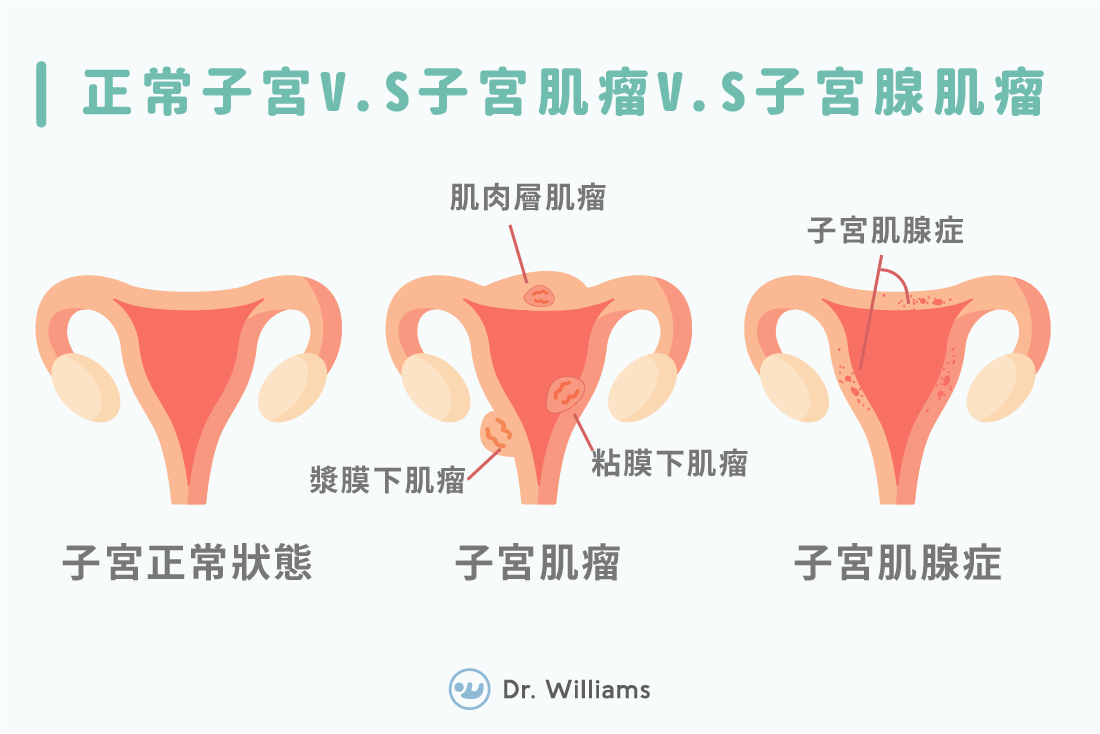 子宮肌瘤與子宮肌腺瘤