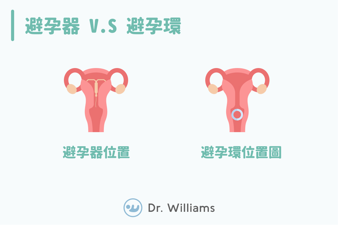 避孕環 V.S 避孕器
