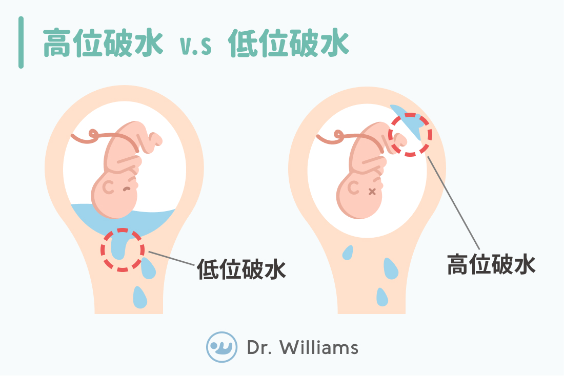 高位破水V.S低位破水